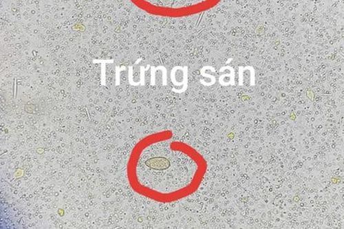 Đau bụng đi khám, người đàn ông 64 tuổi sốc ngang khi thấy ở sán trong người