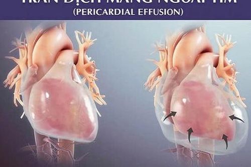 Cấp cứu bệnh nhi bị tràn dịch màng ngoài tim nguy kịch
