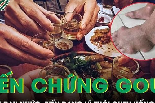 Bàn chân biến dạng, đau nhức dữ dội vì thói quen của nhiều đàn ông Việt