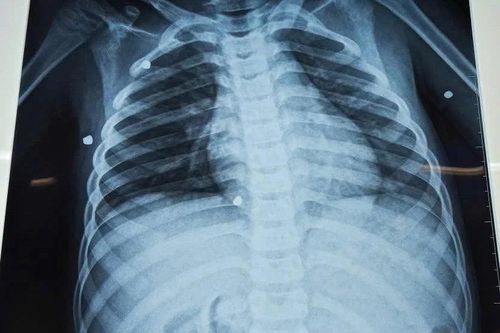 Bé trai bị đa chấn thương nghiêm trọng do nghịch súng hơi