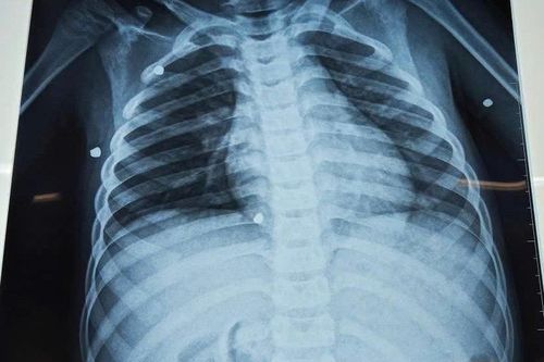 Bé trai 6 tuổi bị đa chấn thương nghiêm trọng do nghịch súng hơi