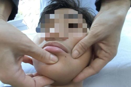 Liệt dây thần kinh số 7 do rét đậm