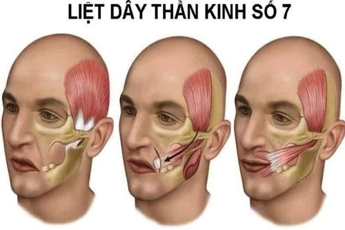 Nhiều ca liệt mặt do nhiễm lạnh kéo dài