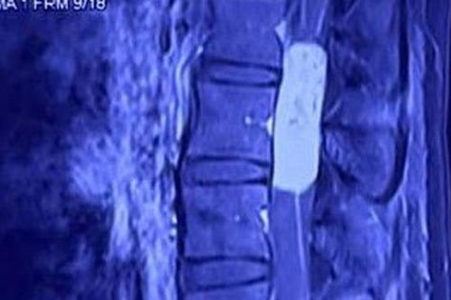 Hạnh phúc nghẹn ngào của người mẹ trẻ sau ca vi phẫu loại bỏ khối u tủy gần 10cm