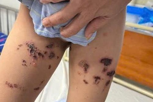 Bé trai bỏng nặng tầng sinh môn do nước tẩy bồn cầu bắn vào người