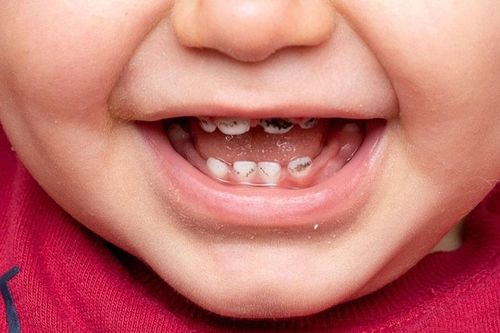 Sâu răng sữa có cần điều trị không?