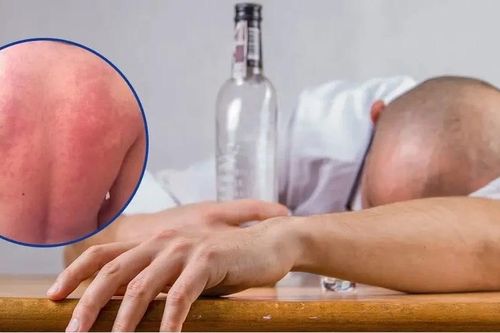 'Mẩn ngứa, nóng bừng' do rượu, bia không đơn thuần là say rượu
