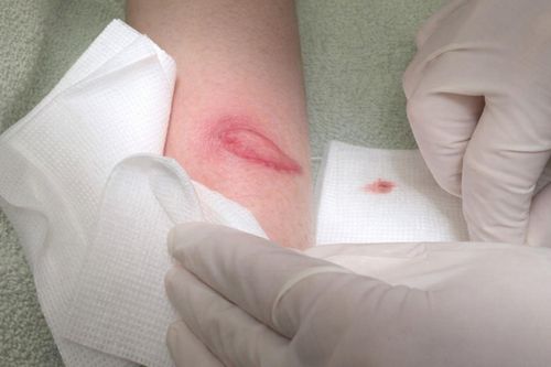 Gánh hậu quả đau lòng vì nôn nóng tiêm filler vòng ba