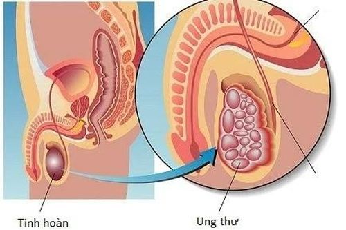 Phương pháp điều trị ung thư tinh hoàn mới, tiên lượng tích cực