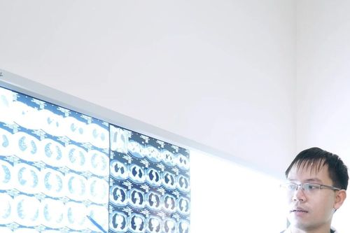 Người phụ nữ Hà Nội viêm phổi do 5 chủng vi khuẩn, virus và nấm khác nhau