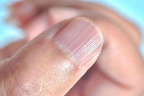 Móng tay nổi sọc dọc, cảnh báo dấu hiệu bất thường vấn đề sức khỏe