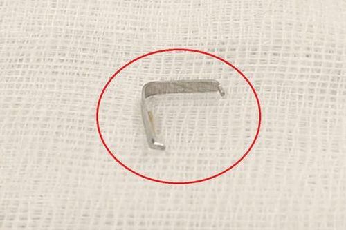 Bé trai 1 tuổi cứ ăn là nôn ọe, bác sĩ phát hiện 'bí mật' bên trong