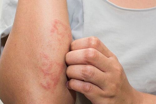 Ngứa râm ran ngoài da tưởng do thời tiết lạnh, không ngờ lại trở thành 'cơn ác mộng' với cô gái trẻ ở Hà Nội