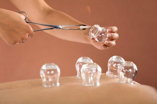 Giác hơi, đánh cảm: Lợi ích khi dùng đúng, hiểm họa khi lạm dụng