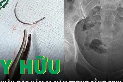 Kim khâu gãy bị bỏ sót, nằm 11 năm trong tầng sinh môn người phụ nữ