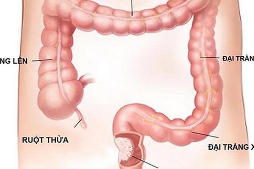 Những lưu ý quan trọng khi nội soi đại tràng, dạ dày bằng gây mê