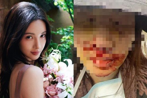 Kim Thần công bố ảnh bị thương nặng ở mặt, cảnh sát làm rõ vụ gây tai nạn bỏ trốn