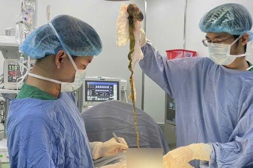Phẫu thuật lấy búi tóc khổng lồ khỏi dạ dày bé trai 6 tuổi ở Đà Nẵng