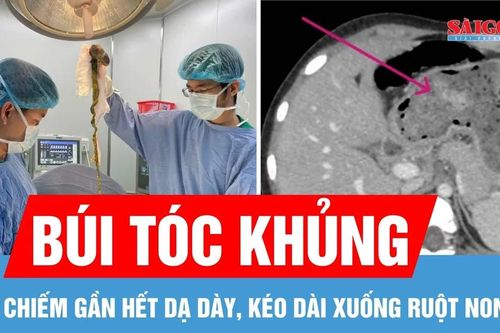 Phẫu thuật lấy búi tóc chiếm gần hết dạ dày, kéo dài xuống ruột non