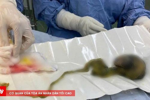Phẫu thuật lấy búi tóc khổng lồ khỏi dạ dày bé trai 6 tuổi ở Đà Nẵng