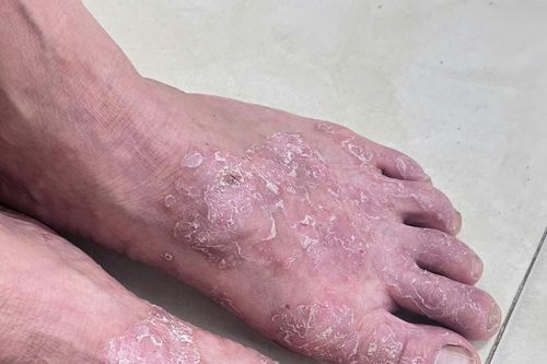 Viêm da cơ địa 'tấn công' dữ dội khi trời rét: Bác sĩ chỉ giải pháp ứng phó