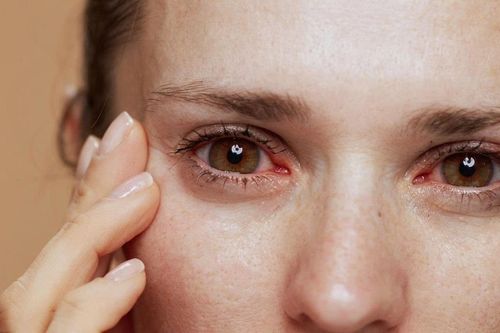 Dấu hiệu gan yếu biểu hiện ở mắt