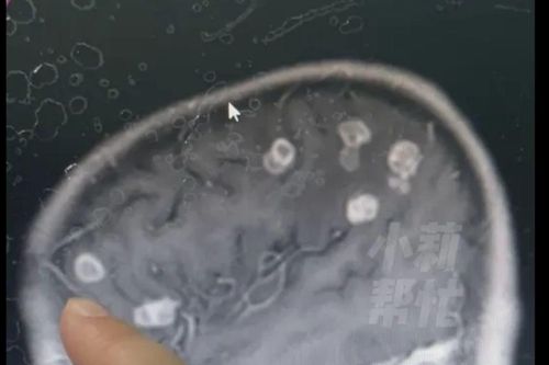 Bé gái 6 tuổi bị sốt suốt 17 ngày sau khi dọn nhà, kết quả kiểm tra khiến bác sĩ sốc