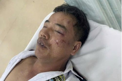 Truy tìm nhóm thanh niên nẹt pô, đánh bảo vệ gãy xương sườn