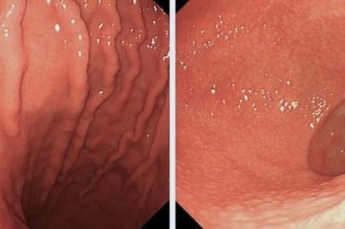 Thói quen ăn uống khiến cả gia đình cùng nhiễm HP dạ dày