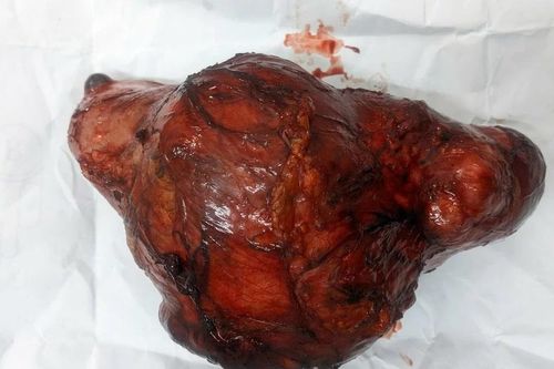 Diễn tiến âm thầm, phát hiện u thận đã nặng 1,2kg