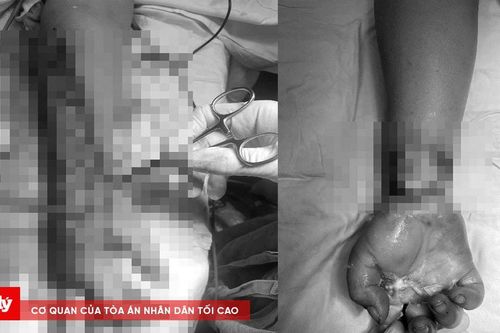 Bị bỏng nặng vì dựng cây nêu chạm đường dây điện