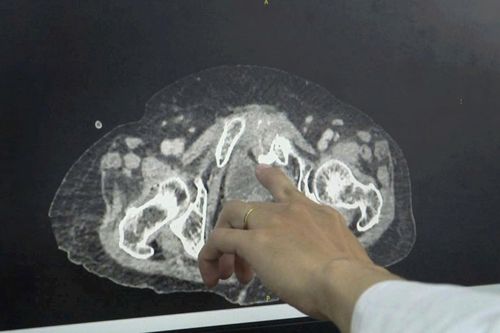 Cứu sống cụ bà bị vỡ bàng quang trong phúc mạc tự phát hiếm gặp