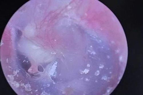 Bé trai 6 tuổi mắc bệnh cholesteatoma tai giữa phá hủy xương