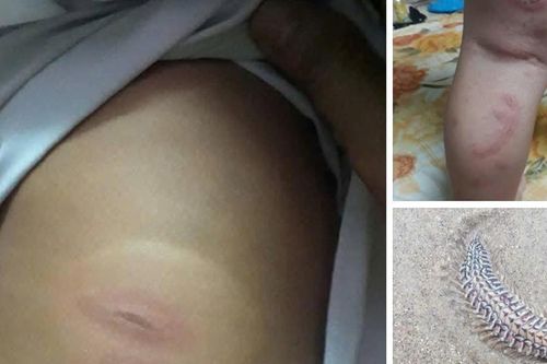 Bệnh viện lên tiếng về thông tin sâu biển cắn bé 3 tuổi nguy kịch, cần truyền máu gấp