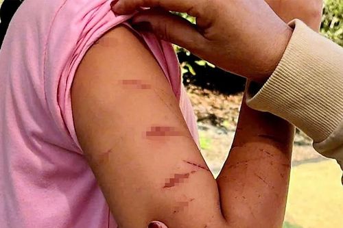 Bé gái 12 tuổi đến trường với vết thương trên tay, giáo viên lập tức báo công an