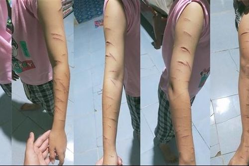 Điều tra vụ nữ sinh lớp 5 ở Cà Mau bị nhiều vết thương