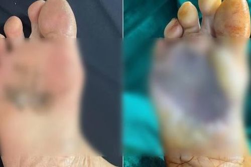 Ung thư da tiềm ẩn từ tổn thương không đau, không ngứa