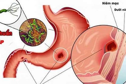 Tập luyện thể chất: Giải pháp không mất tiền phòng ngừa và hỗ trợ điều trị viêm loét dạ dày- tá tràng