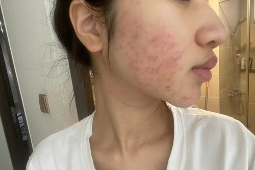 Gánh hậu quả vì áp lực làm đẹp kịp Tết
