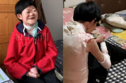 Từng bị chẩn đoán không sống quá 2 tuổi, 'cô gái bươm bướm' hiện tại ra sao ở tuổi 25?