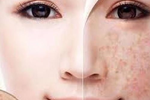 Nhận diện thủ phạm gây đốm đồi mồi trên da