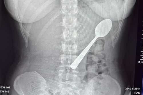 Đang ăn sữa chua, người phụ nữ nuốt chiếc thìa dài 17cm vào bụng