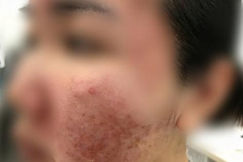 Cơn ác mộng của thiếu nữ chỉ sau vài giờ được mời làm đẹp cấp tốc đón Tết