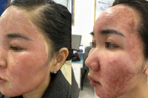 'Làm đẹp cấp tốc' đón Tết, cô gái hỏng cả khuôn mặt