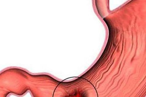 Viêm loét dạ dày dễ tái phát vào dịp cuối năm