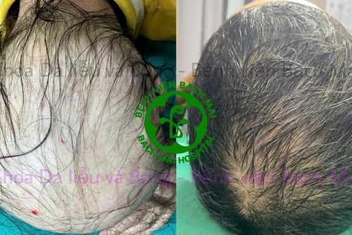 Chăm sóc tóc đúng cách, tránh tổn thương nang tóc lâu dài