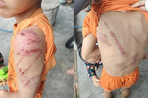 Xác minh vụ bé trai 10 tuổi ở Đắk Lắk nghi bị bố ruột bạo hành