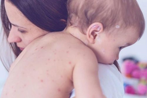Trẻ bị thủy đậu ăn gì để nhanh khỏi?