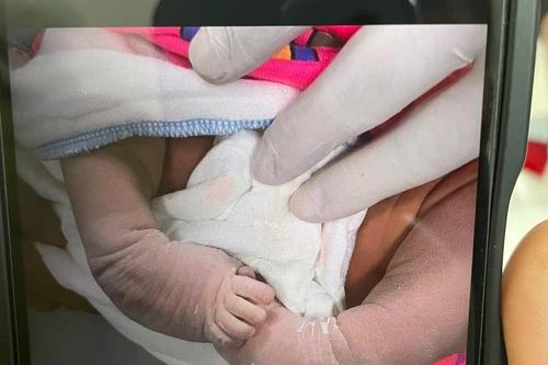 Chữa chân khoèo cho trẻ ngay từ những ngày đầu đời