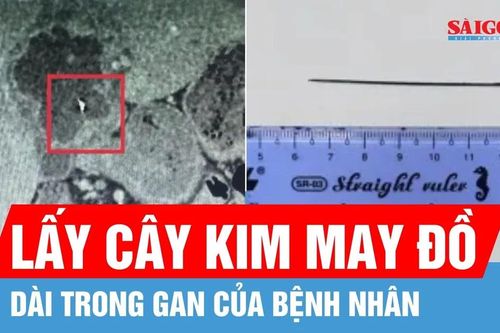 Hy hữu: Kim khâu dài 6cm nằm trong gan người đàn ông